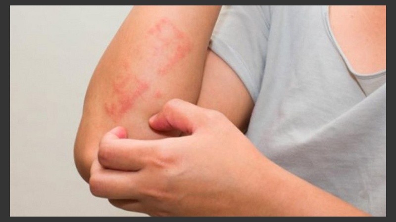 La estación de calor es una época muy beneficiosa para las personas con psoriasis.