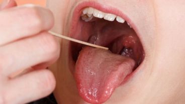 En general, los casos de fiebre y dolor en garganta son de origen viral.