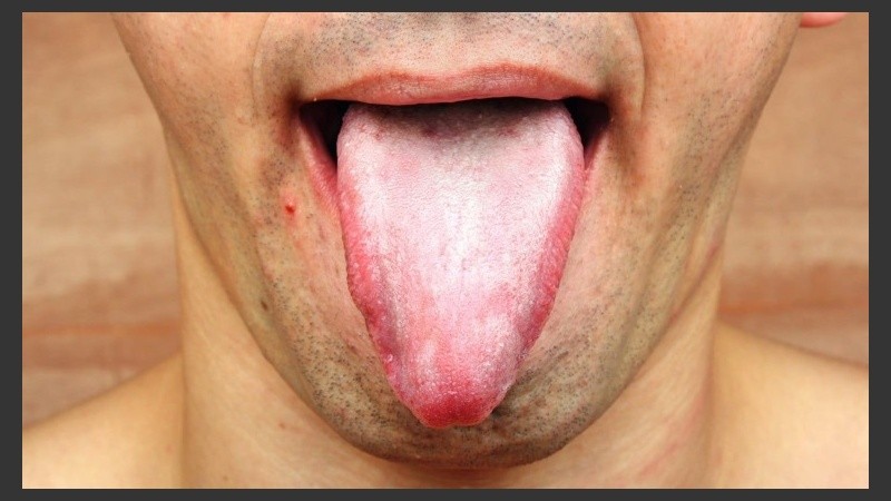 Es común confundir los síntomas de la saburra lingual con los de la enfermedad de Bowen. 