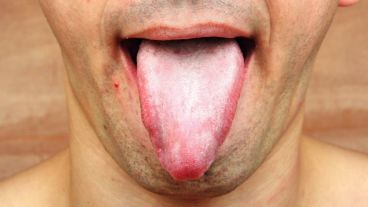 Es común confundir los síntomas de la saburra lingual con los de la enfermedad de Bowen.