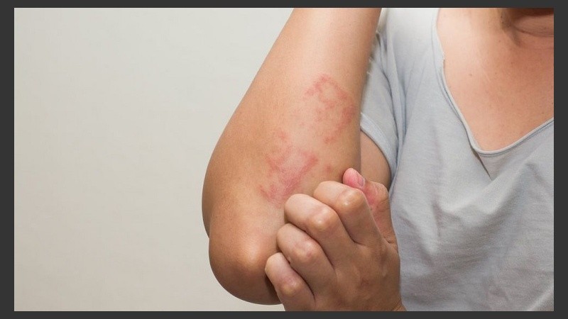 El principal síntoma es el picor.