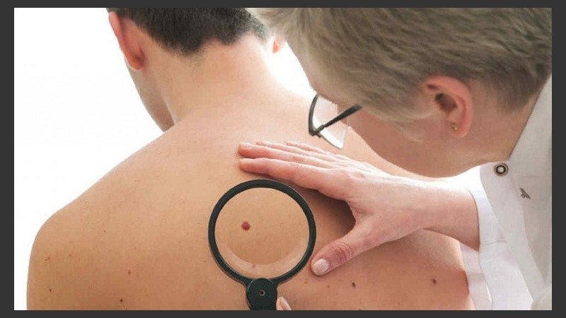 Un cambio de apariencia en la piel es el primer signo del melanoma.