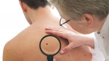 Un cambio de apariencia en la piel es el primer signo del melanoma.