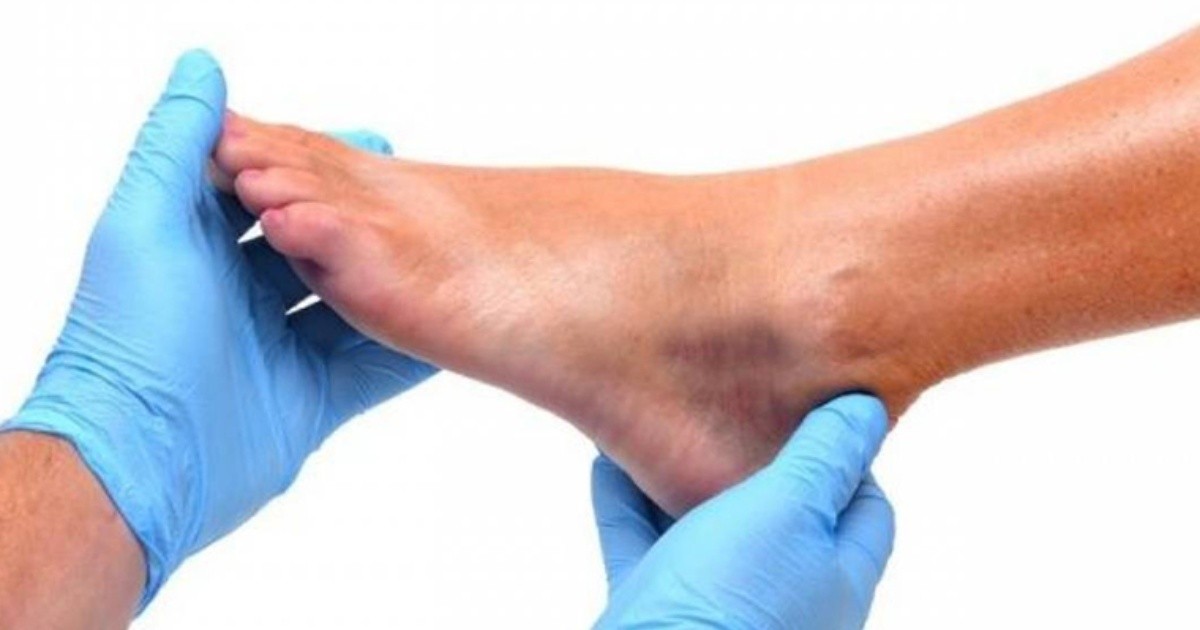 ¿Qué es necesario saber sobre el pie diabético? Rosario3