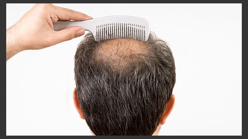 Hay esperanza contra la calvicie.