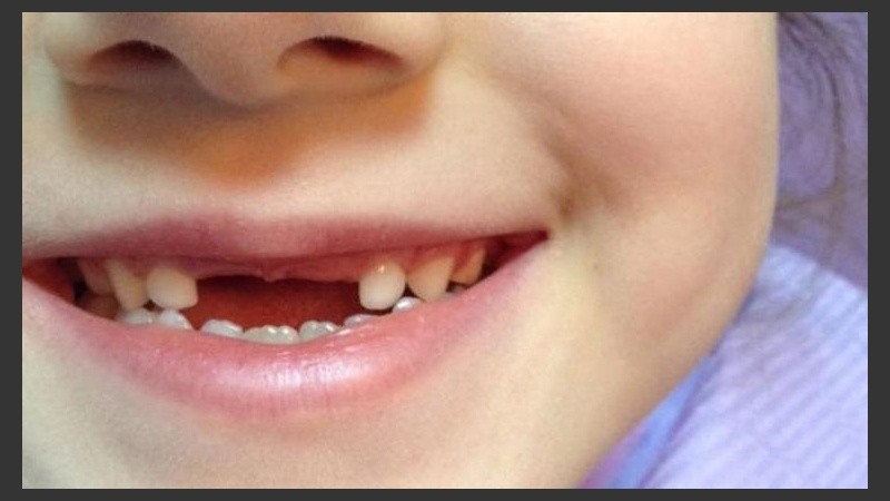 Un método muy particular para sacar un diente.