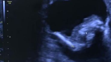 La ecografía descubrió la presencia de un feto en el cuerpo de la niña.