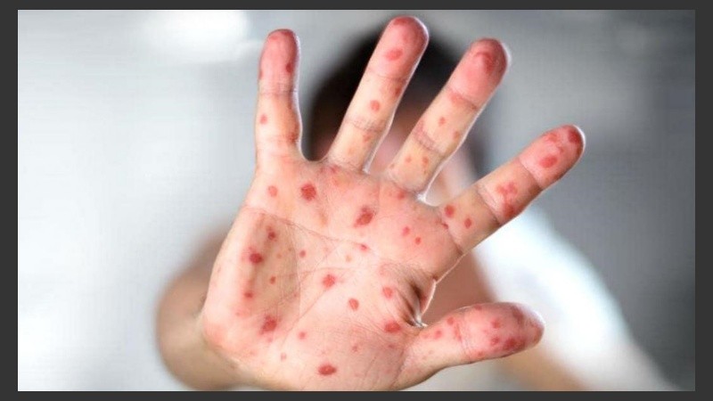 Ya suman 10 los casos de sarampión este año. 