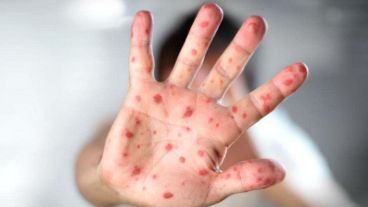 Ya suman 10 los casos de sarampión este año.