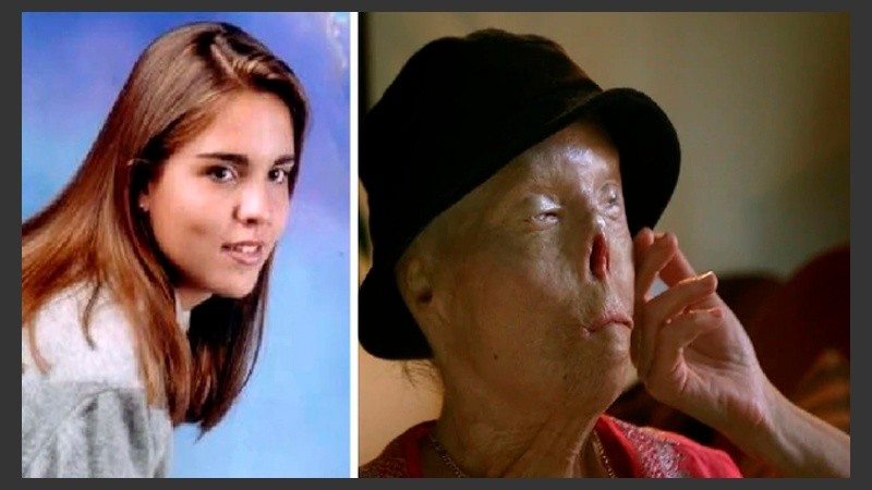 Cuando sufrió el accidente tenía 20 años y sobrevivió otros 20 hasta que el cáncer le dio un punto final 