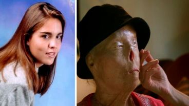 Cuando sufrió el accidente tenía 20 años y sobrevivió otros 20 hasta que el cáncer le dio un punto final 