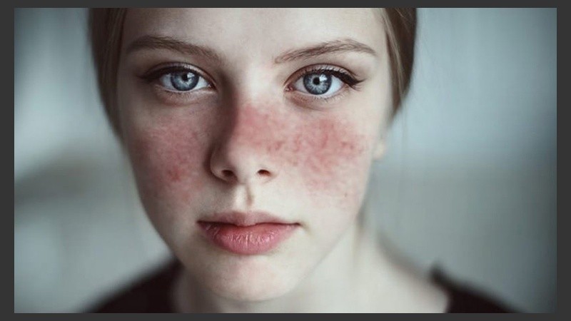 El lupus afecta a cualquier persona, pero especialmente a las mujeres.