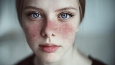 El lupus afecta a cualquier persona, pero especialmente a las mujeres.