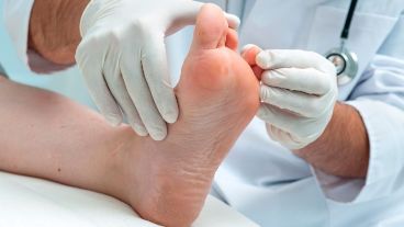 La neuropatía de los pies combinada con la reducción del flujo sanguíneo incrementan el riesgo de úlceras de los pies, infección y, en última instancia, amputación.