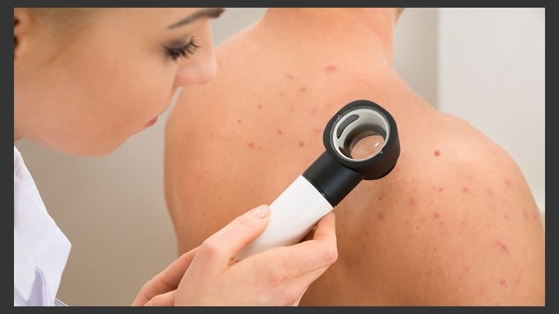 El 85% de los pacientes con hidradenitis supurativa ven afectada su vida diaria, incluyendo aspectos emocionales, psicológicos, sexuales y laborales.