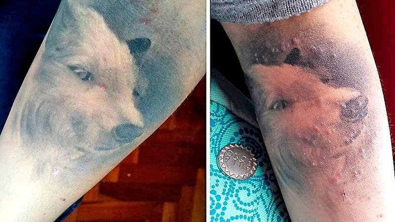 El tatuaje tatuaje, antes y despuÃ©s de la bacteria. 