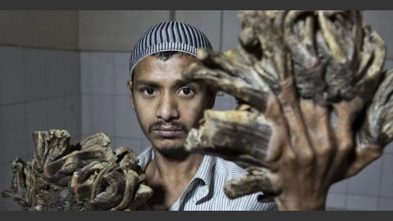 Abul Bajandar también tiene verrugas en los pies, pero éstas están menos extendidas.