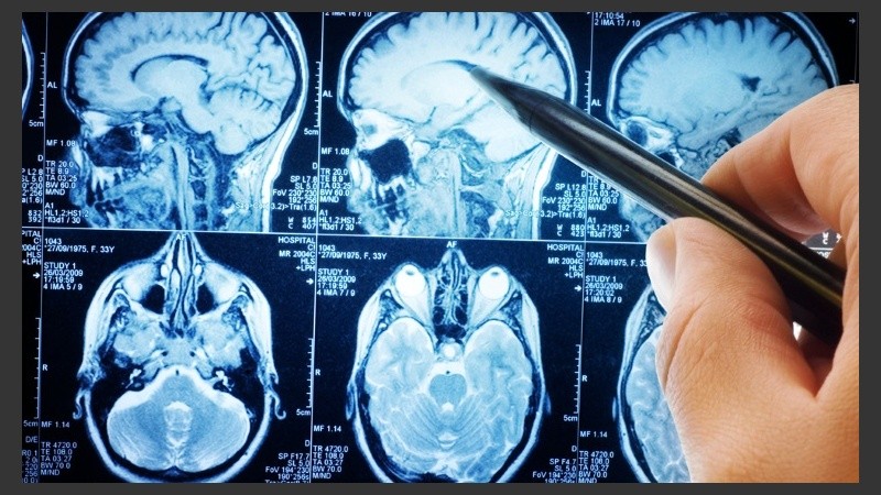 El equipo de investigación examinó el líquido cefalorraquídeo de 69 personas, todas las cuales habían estado en terapia contra el VIH.