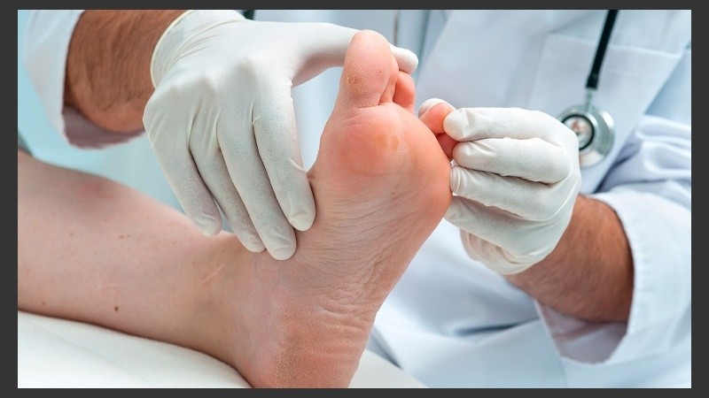 Las úlceras y amputaciones son un gran problema de salud