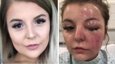 La joven recomendó no cocinar huevos en el microondas tras el accidente doméstico.