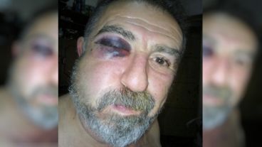 Así le quedó el ojo derecho a Roberto.