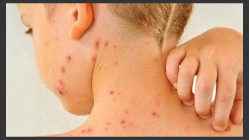 En Argentina no había casos locales desde el año 2000.