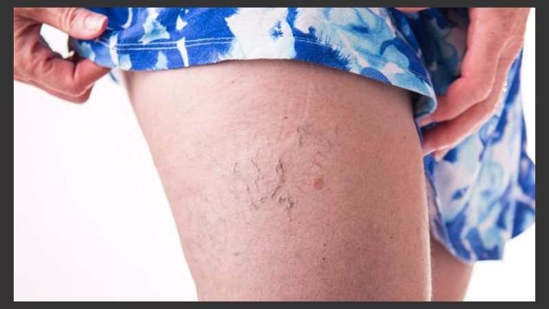 La aparición de las arañitas hace que las personas consulten al médico pensando en la estética.