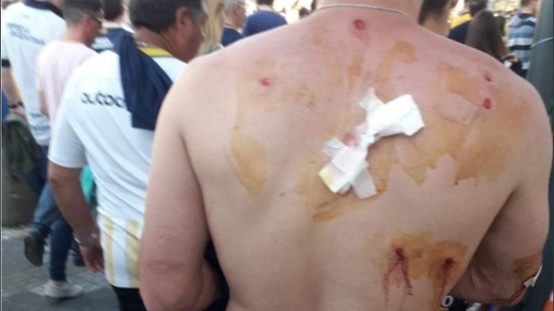 Eric, un hincha canalla mostró cómo quedó su espalda. 