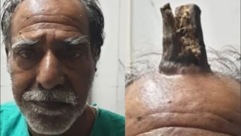 Al Cuerno Sebáceo también se lo conoce como el 