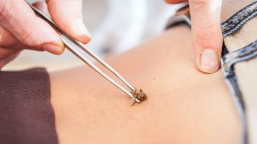 Muchos expertos sostienen que en realidad esta técnica es la base de la acupuntura.