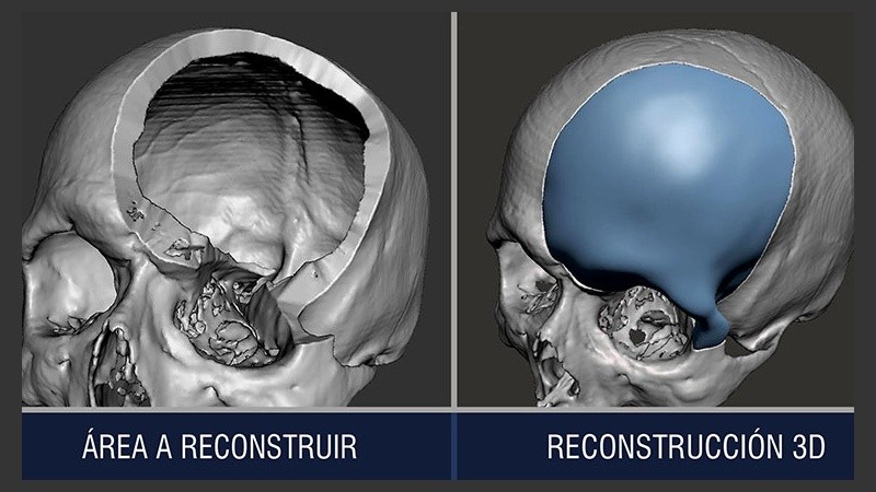 Descripción gráfica del área del cráneo que se reconstruyó.