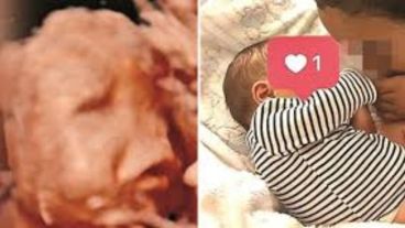 Los médicos no detectaron la malformación durante el embarazo.