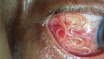 El paciente podía sentir que le sacaban el gusano