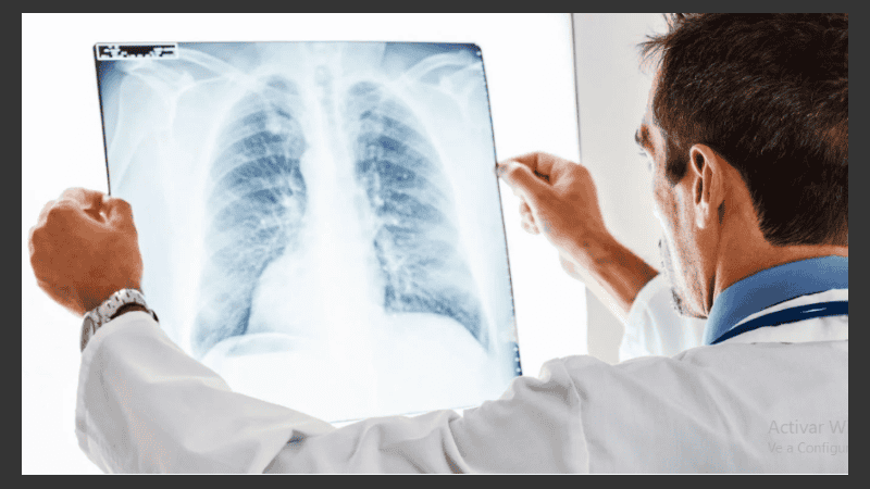 Los nódulos pulmonares pueden ser cancerosos, aunque la mayoría no lo son.