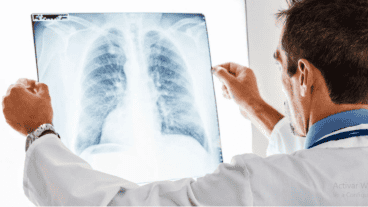 Los nódulos pulmonares pueden ser cancerosos, aunque la mayoría no lo son.