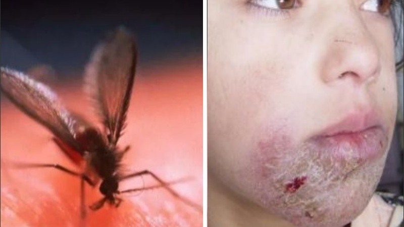 La forma más común de trasmisión es a través de la picadura de un insecto infectado.