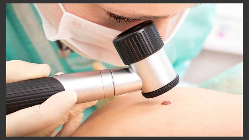 Para la mayoría de los pacientes, el melanoma comienza con una pequeña mancha pigmentada en la piel que