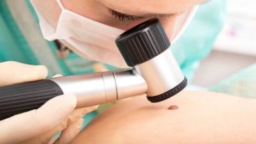 Para la mayoría de los pacientes, el melanoma comienza con una pequeña mancha pigmentada en la piel que