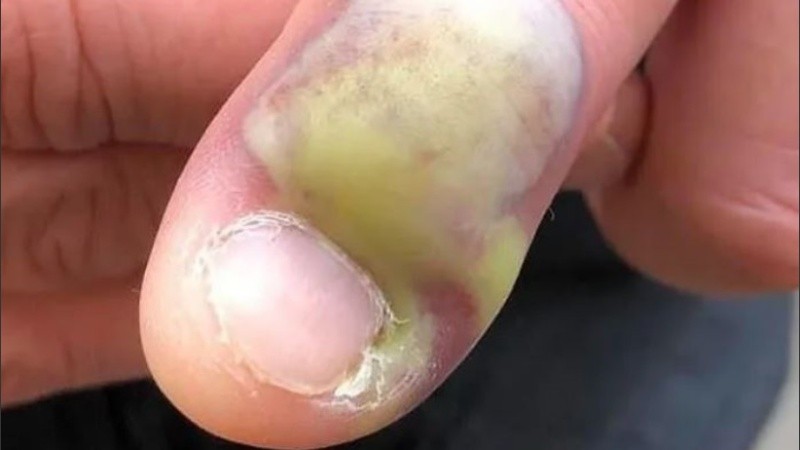 El hombre fue operado y se recupera.