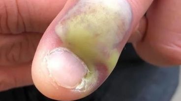 El hombre fue operado y se recupera.