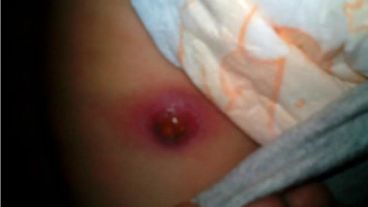 La herida confundida con una mordedura.