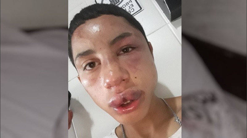 Así quedó el rostro de Julián, el chico atacado en patota.