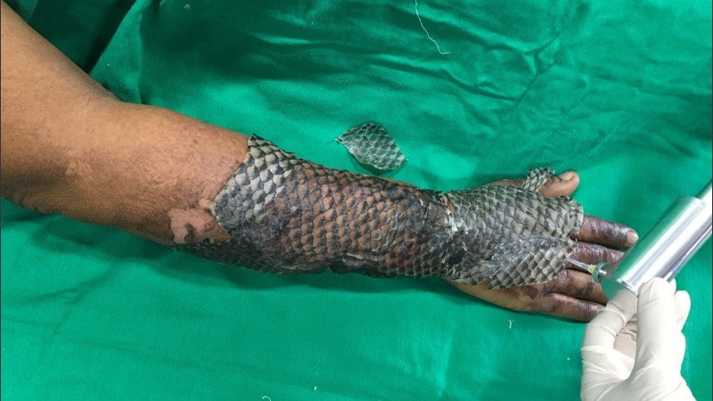 Las propiedades de la piel de tilapia se siguen investigando en varios estados en Brasil.