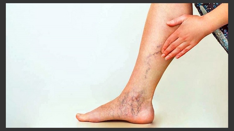 La consulta apunta a resolver una cuestión estética; ya que raramente nos encontramos con una insuficiencia venosa crónica.