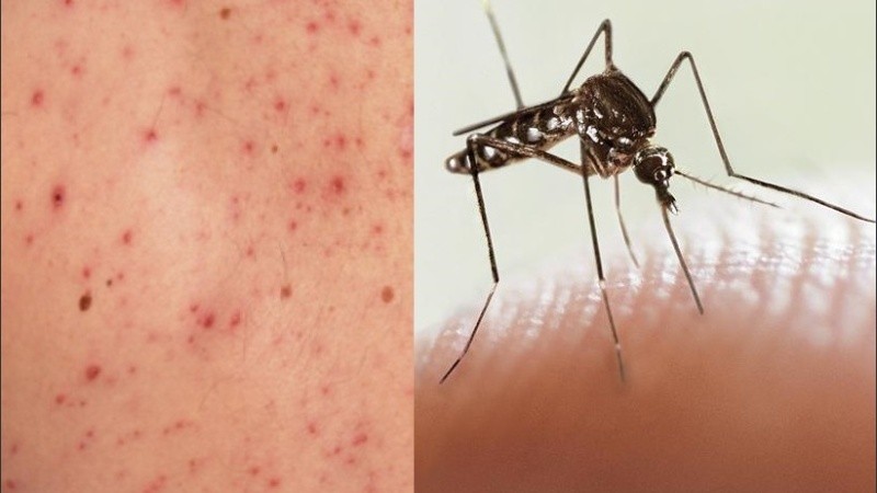 El tratamiento del dengue es sintomático, se medica para paliar los síntomas.