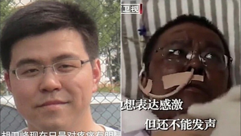 El antes y el después del Dr. Hu Weifeng.
