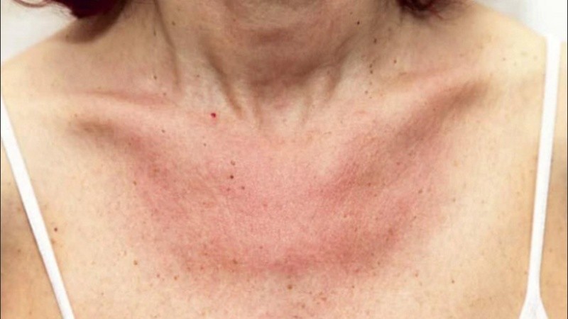 Cada uno de estos patrones se ha podido asociar con unas características específicas de pacientes, evolución y gravedad de la enfermedad.