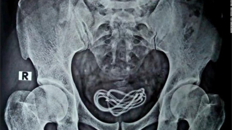 El hombre tenía un cable de cargador de 60 centímetros de largo dentro su vejiga.