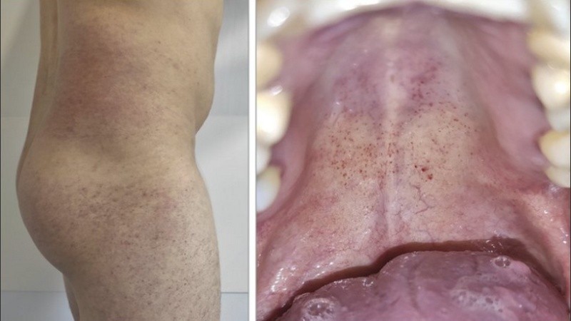 Muestras del sarpullido que aparece en la boca de algunos pacientes con Covid-19 (Hospital Universitario Ramon y Cajal de Madrid).