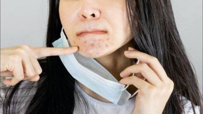 Los granitos fruto de la fricción de la tela del barbijo en la piel. 